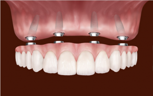 Dental Implants In Rockville MD